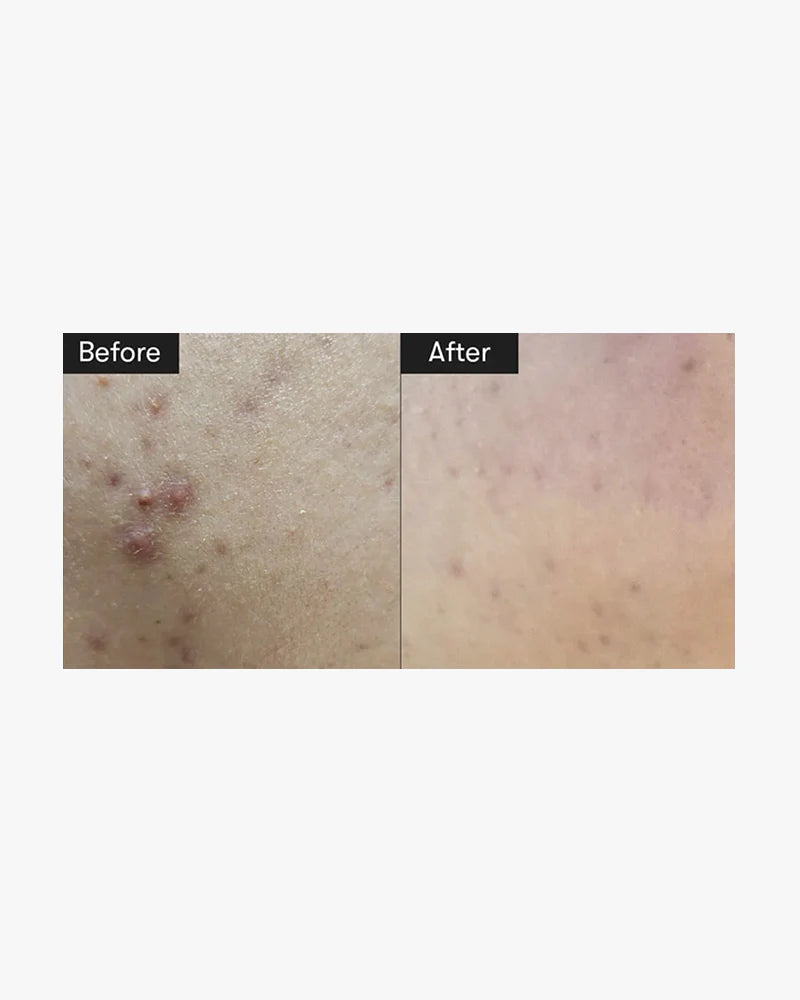 VT - REEDLE SHOT 300 SERUM